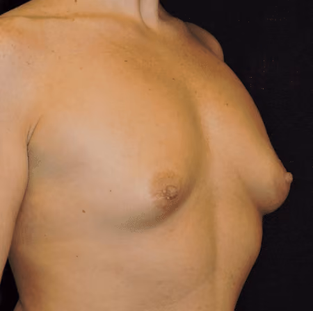Breast Augmentation before and after, case 4554 - Cool Springs Plastic Surgery