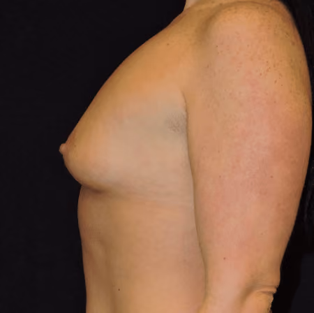 Breast Augmentation before and after, case 4554 - Cool Springs Plastic Surgery