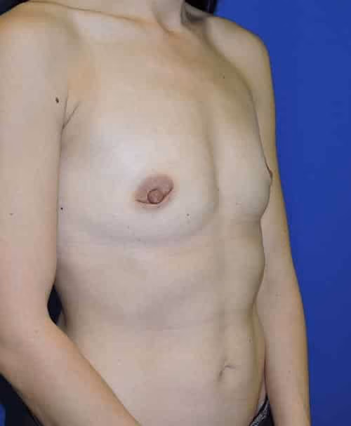 Breast Augmentation before and after, case 4723 - Cool Springs Plastic Surgery