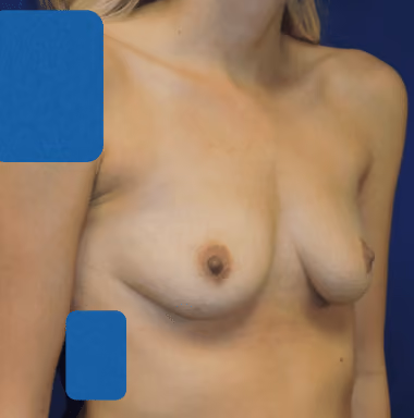 Breast Augmentation before and after, case 4874 - Cool Springs Plastic Surgery