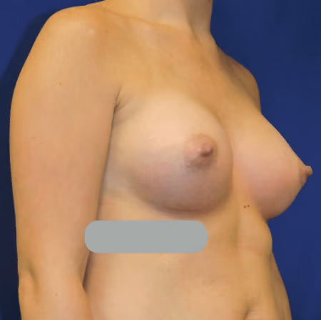 Breast Augmentation before and after, case 5260 - Cool Springs Plastic Surgery