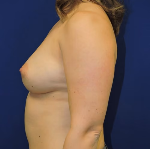 Breast Augmentation before and after, case 5509 - Cool Springs Plastic Surgery