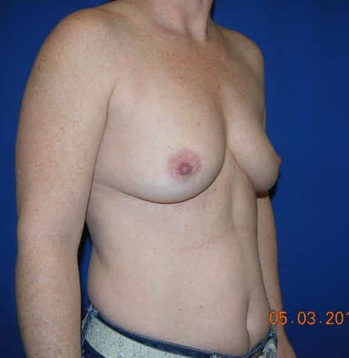 Breast Augmentation before and after, case 5691 - Cool Springs Plastic Surgery
