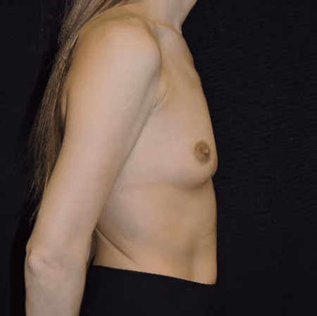 Breast Augmentation before and after, case 5782 - Cool Springs Plastic Surgery