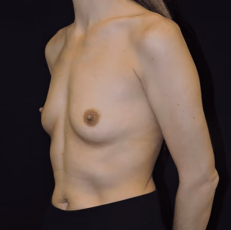 Breast Augmentation before and after, case 5782 - Cool Springs Plastic Surgery