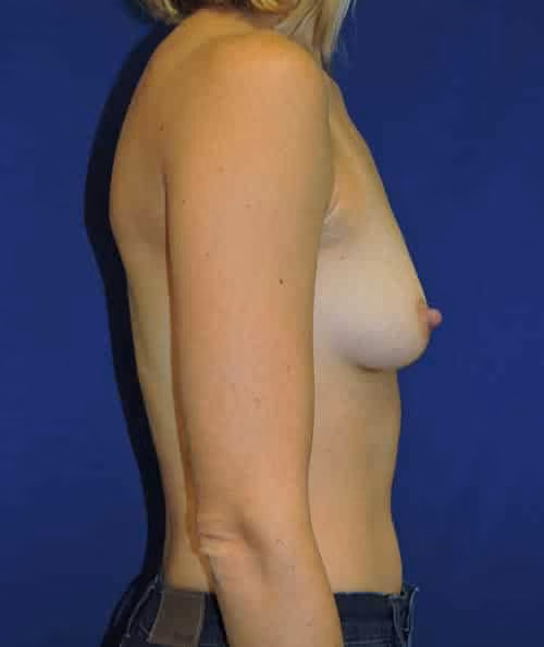Breast Augmentation before and after, case 5950 - Cool Springs Plastic Surgery