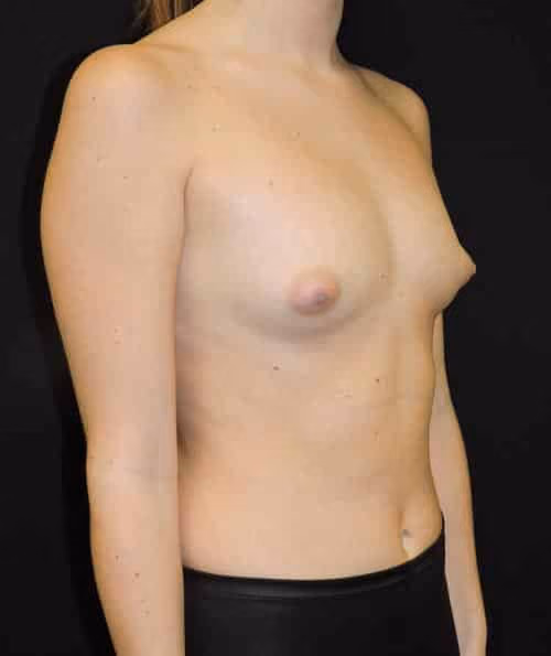 Breast Augmentation before and after, case 5991 - Cool Springs Plastic Surgery