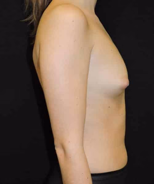 Breast Augmentation before and after, case 5991 - Cool Springs Plastic Surgery
