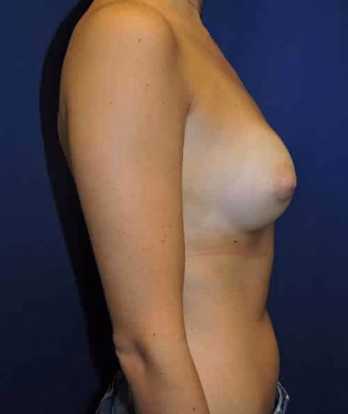 Breast Augmentation before and after, case 5991 - Cool Springs Plastic Surgery