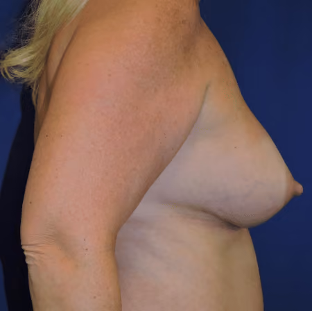 Breast Augmentation before and after, case 6029 - Cool Springs Plastic Surgery