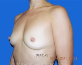 Breast Augmentation before and after, case 6142 - Cool Springs Plastic Surgery