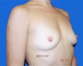 Breast Augmentation before and after, case 6142 - Cool Springs Plastic Surgery