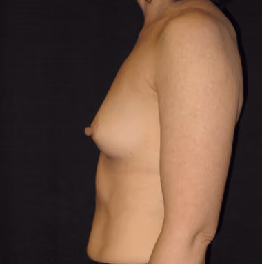 Breast Augmentation before and after, case 6204 - Cool Springs Plastic Surgery