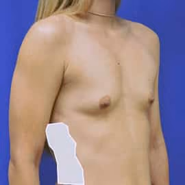 Breast Augmentation before and after, case 6222 - Cool Springs Plastic Surgery