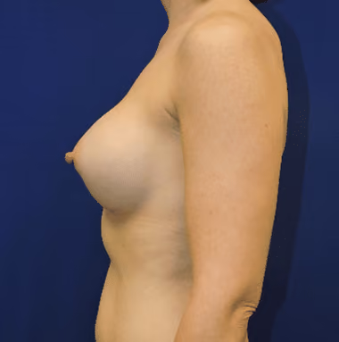 Breast Augmentation before and after, case 6204 - Cool Springs Plastic Surgery