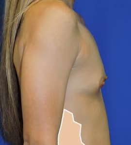 Breast Augmentation before and after, case 6222 - Cool Springs Plastic Surgery