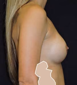Breast Augmentation before and after, case 6222 - Cool Springs Plastic Surgery