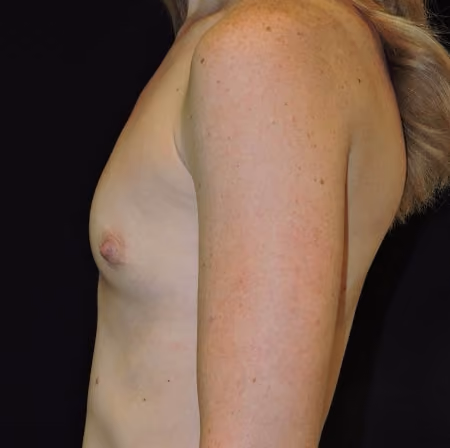 Breast Augmentation before and after, case 6253 - Cool Springs Plastic Surgery