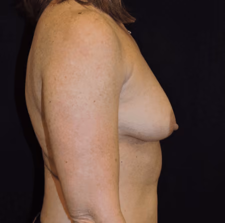 Breast Augmentation before and after, case 6294 - Cool Springs Plastic Surgery