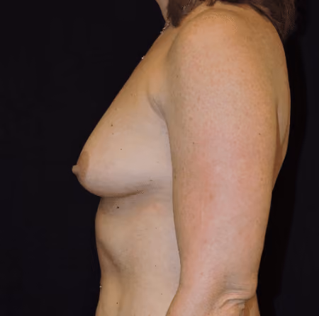 Breast Augmentation before and after, case 6294 - Cool Springs Plastic Surgery