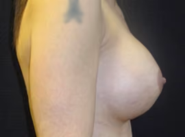 Breast Augmentation before and after, case 6378 - Cool Springs Plastic Surgery
