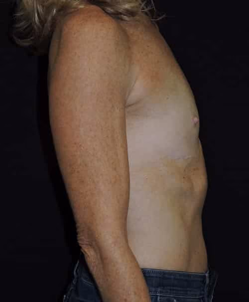 Breast Augmentation before and after, case 6399 - Cool Springs Plastic Surgery
