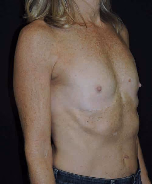 Breast Augmentation before and after, case 6399 - Cool Springs Plastic Surgery