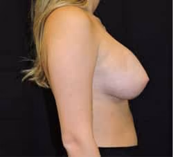 Breast Augmentation before and after, case 6444 - Cool Springs Plastic Surgery