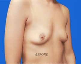 Breast Augmentation before and after, case 6524 - Cool Springs Plastic Surgery