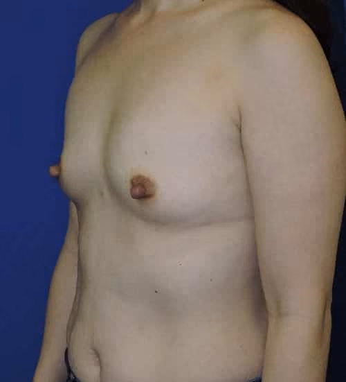 Breast Augmentation before and after, case 6589 - Cool Springs Plastic Surgery