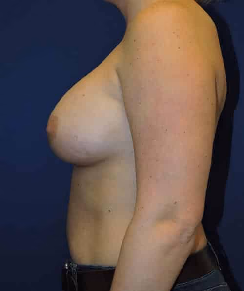 Breast Augmentation before and after, case 6795 - Cool Springs Plastic Surgery