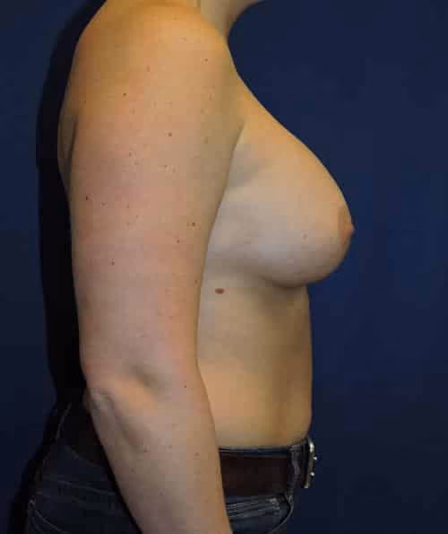 Breast Augmentation before and after, case 6795 - Cool Springs Plastic Surgery