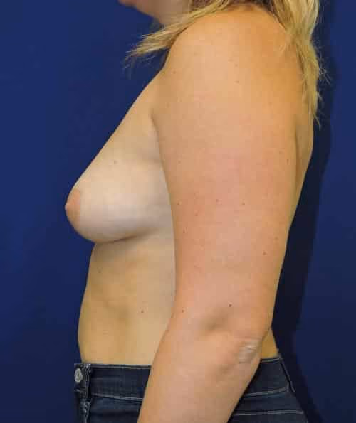 Breast Augmentation before and after, case 6795 - Cool Springs Plastic Surgery