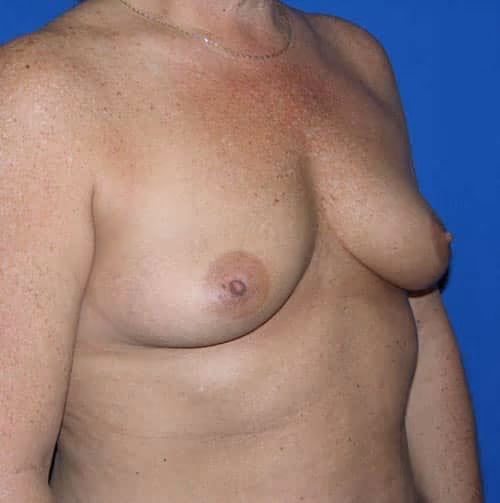 Breast Augmentation before and after, case 6915 - Cool Springs Plastic Surgery