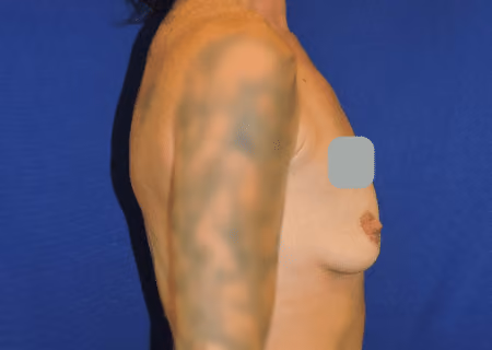 Breast Augmentation before and after, case 6937 - Cool Springs Plastic Surgery