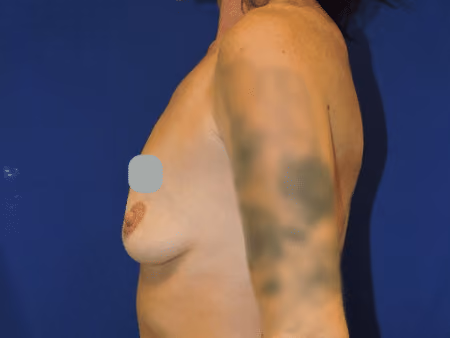 Breast Augmentation before and after, case 6937 - Cool Springs Plastic Surgery