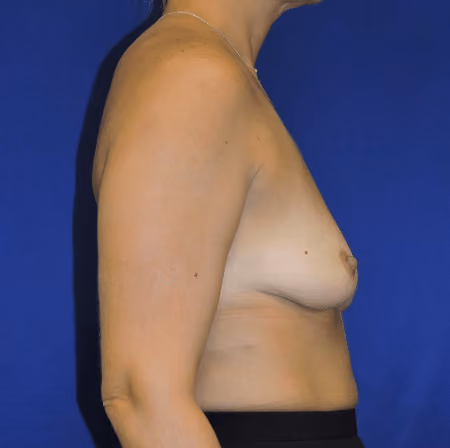Breast Augmentation before and after, case 5815 - Cool Springs Plastic Surgery