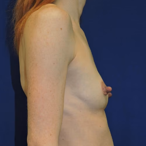 Breast Augmentation before and after, case 7153 - Cool Springs Plastic Surgery