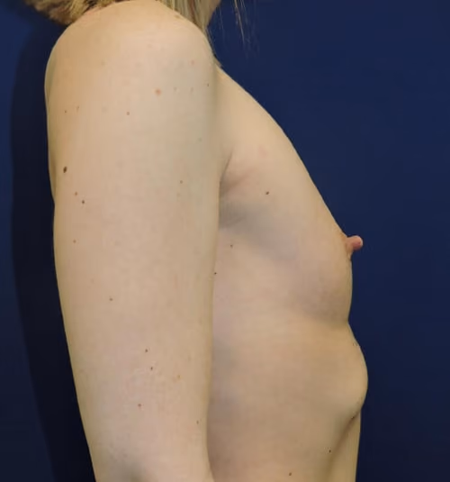 Breast Augmentation before and after, case 7176 - Cool Springs Plastic Surgery