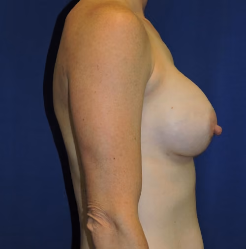 Breast Augmentation before and after, case 7196 - Cool Springs Plastic Surgery