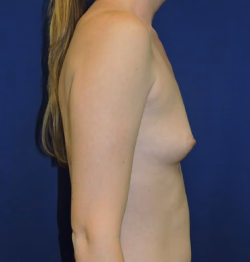 Breast Augmentation before and after, case 7243 - Cool Springs Plastic Surgery