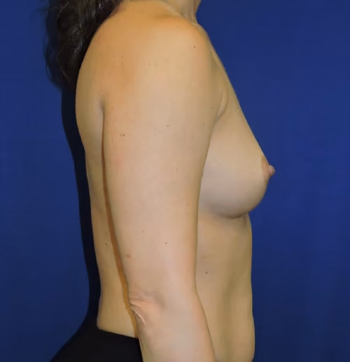 Breast Augmentation before and after, case 7254 - Cool Springs Plastic Surgery