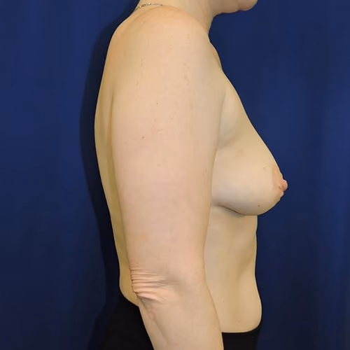 Breast Augmentation before and after, case 7342 - Cool Springs Plastic Surgery