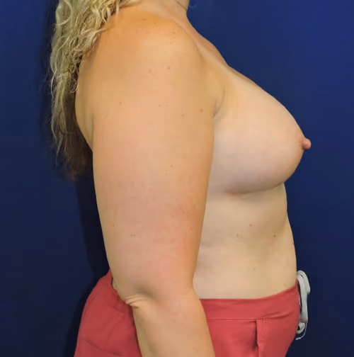 Breast Augmentation before and after, case 7353 - Cool Springs Plastic Surgery