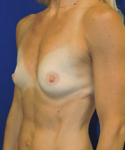 Breast Augmentation before and after, case 7374 - Cool Springs Plastic Surgery