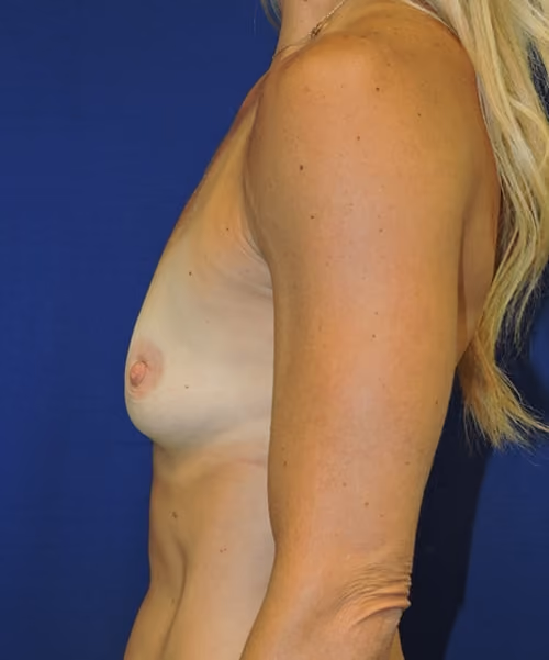 Breast Augmentation before and after, case 7374 - Cool Springs Plastic Surgery