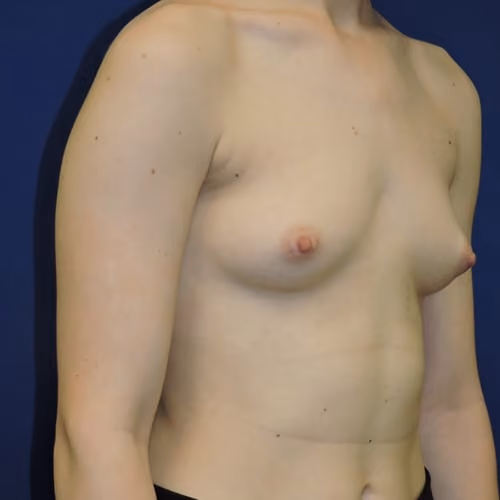 Breast Augmentation before and after, case 7422 - Cool Springs Plastic Surgery