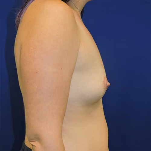 Breast Augmentation before and after, case 7487 - Cool Springs Plastic Surgery