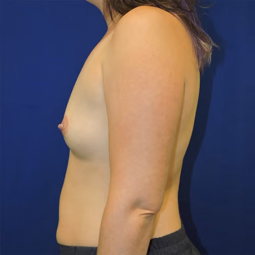 Breast Augmentation before and after, case 7487 - Cool Springs Plastic Surgery