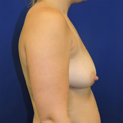 Breast Augmentation before and after, case 7442 - Cool Springs Plastic Surgery